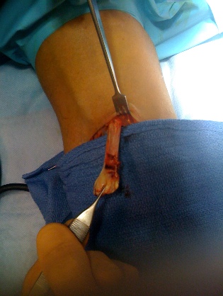 Tendon conjoint rompu