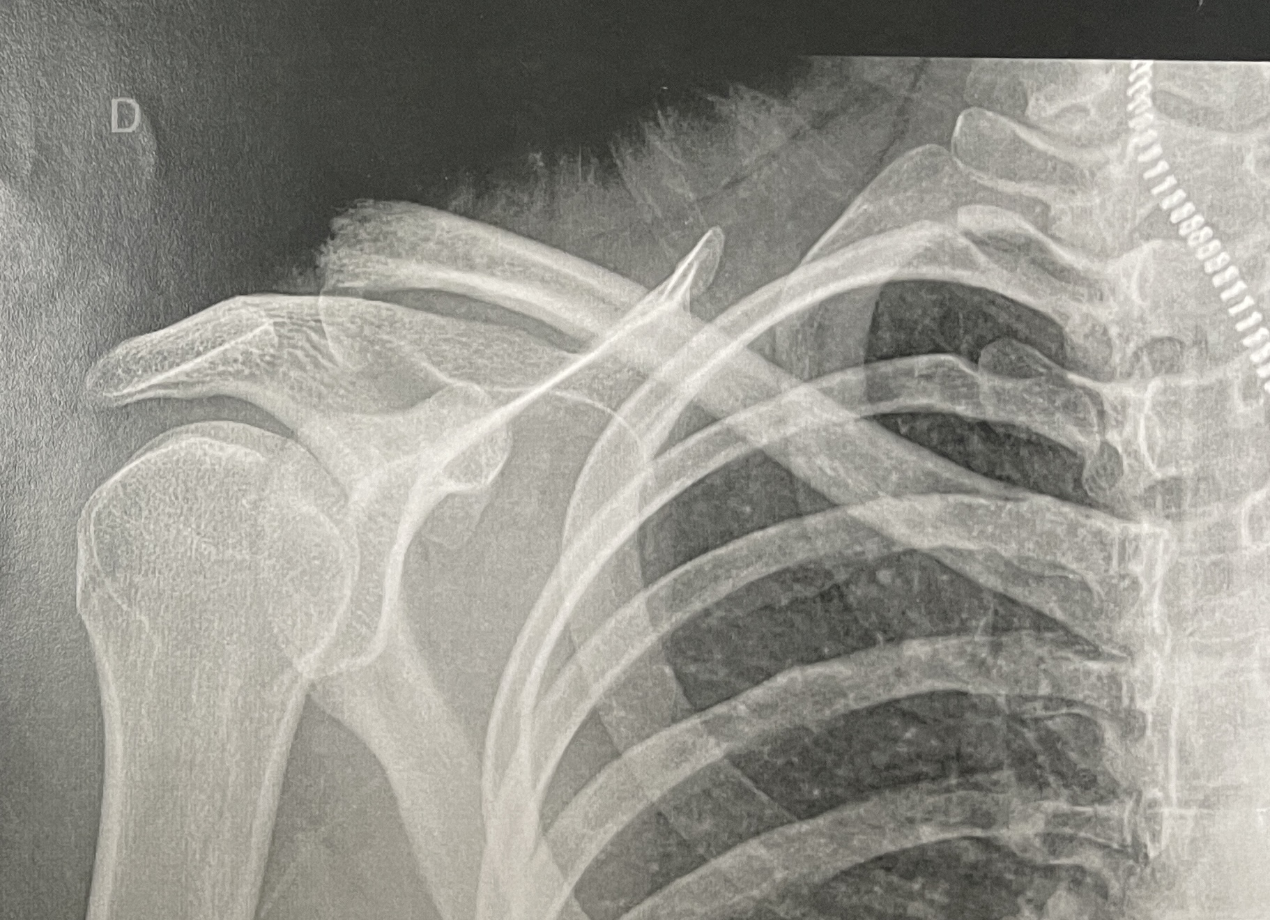 Fracture de la clavicule dr Chivot